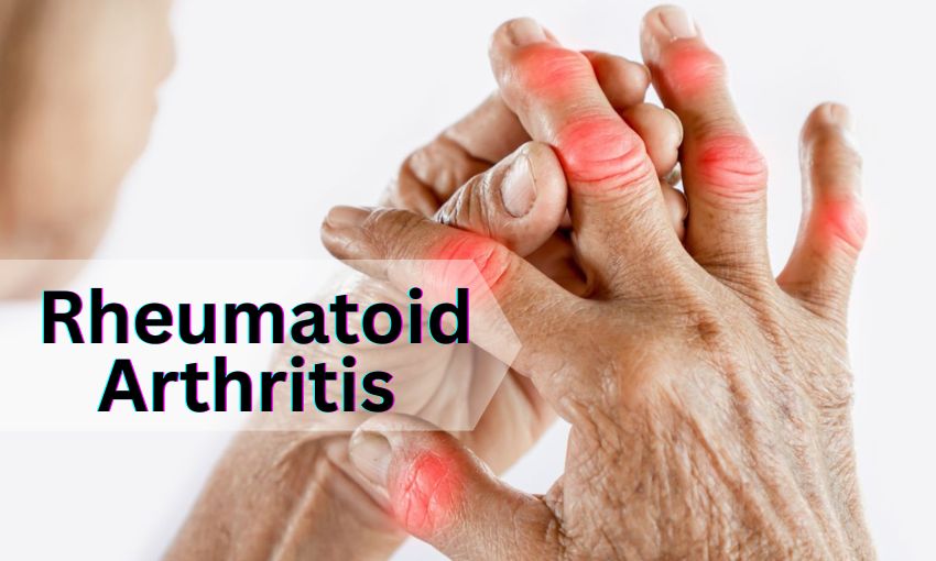 Rheumatoid Arthritis: Symptoms, Causes, Treatment