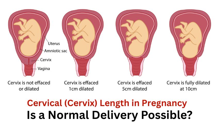 Cervical (Cervix) Length in Pregnancy: Is a Normal Delivery Possible