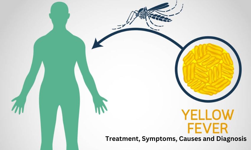 Yellow Fever Treatment