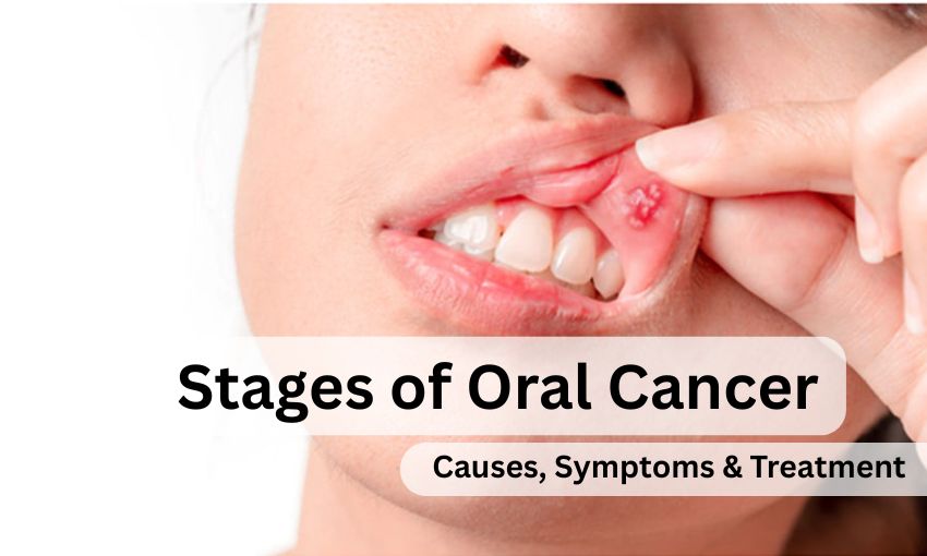 Stages of Oral Cancer
