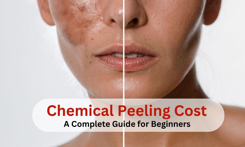 Chemical Peeling Cost