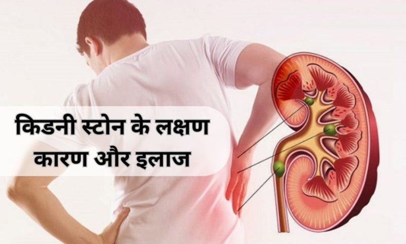 Kidney Stones in Hindi: किडनी स्टोन के लक्षण, कारण और इलाज