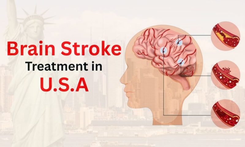 Brain Stroke Treatment in USA: Types, Symptoms & Recovery