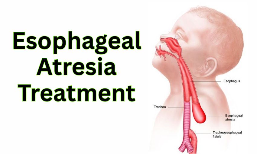 Esophageal Atresia Treatment