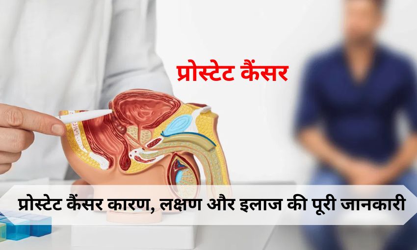Prostate Cancer in Hindi – प्रोस्टेट कैंसर कारण, लक्षण और इलाज की पूरी जानकारी