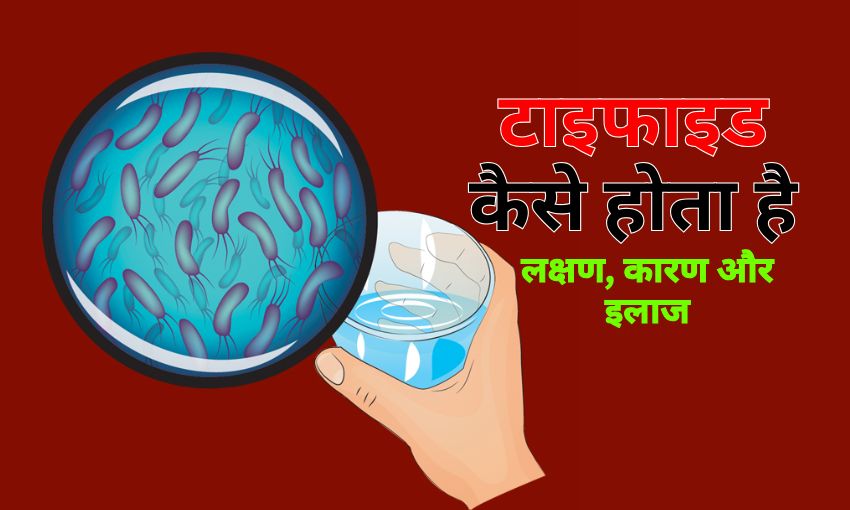 टाइफाइड कैसे होता है: लक्षण, कारण, और इलाज-Typhoid in Hindi