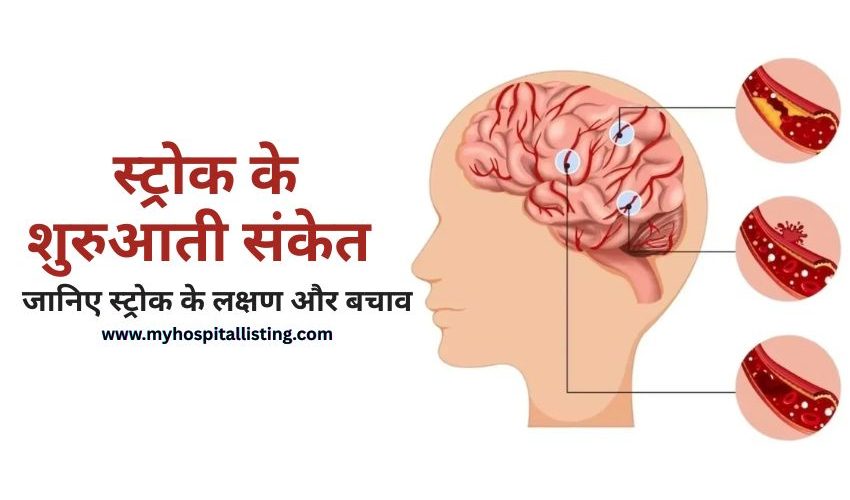 Brain Stroke Kya Hota Hai -स्ट्रोक के लक्षण, कारण और बचाव की पूरी जानकारी